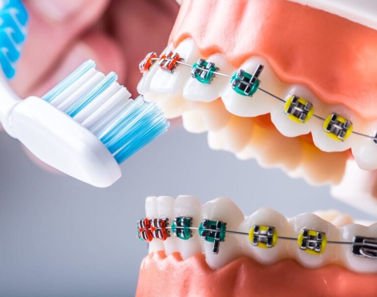 Ultimate Guide: How to Use an Electronic Toothbrush with Braces